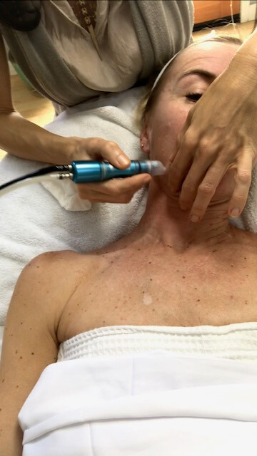 microdermabrasion - alternatives to botox