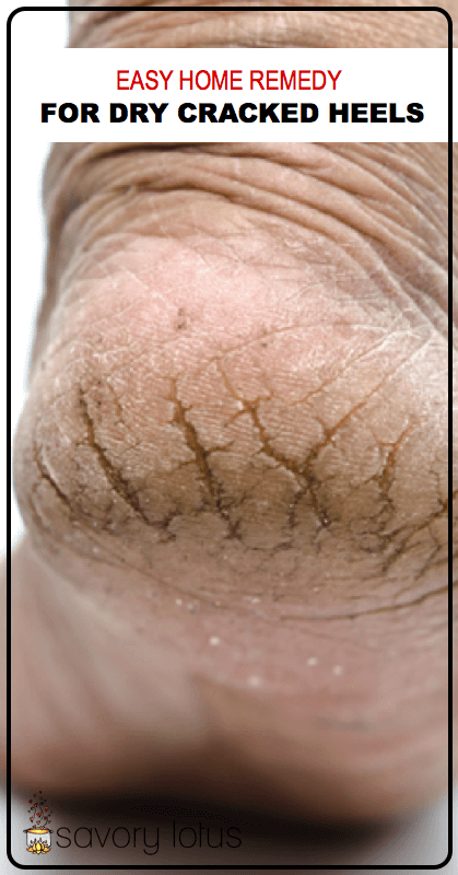 dried cracked skin on heel