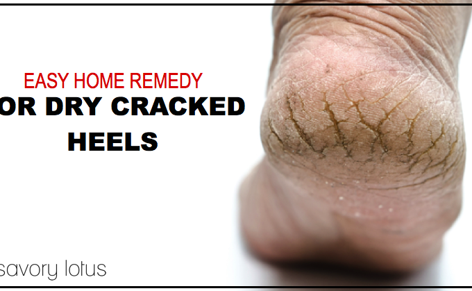 dry heels, cracked heels, how to heal, DIY