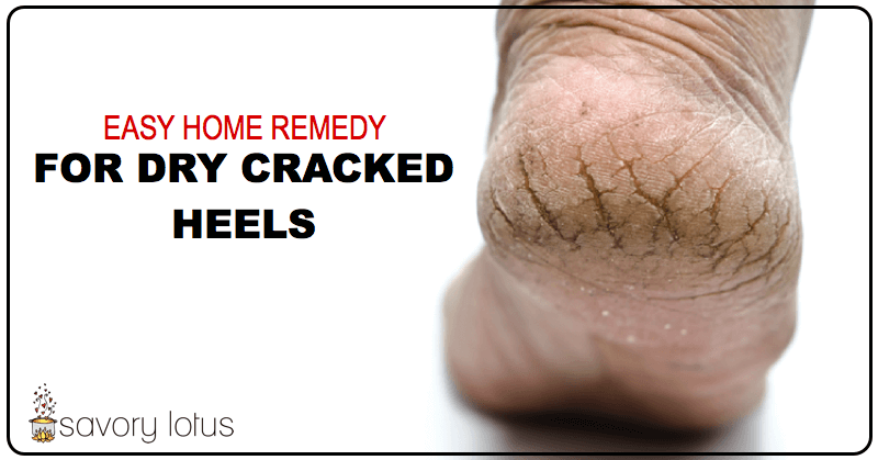 dried cracked heel